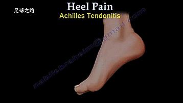 足跟痛的症状及表现,足跟痛最常见病因