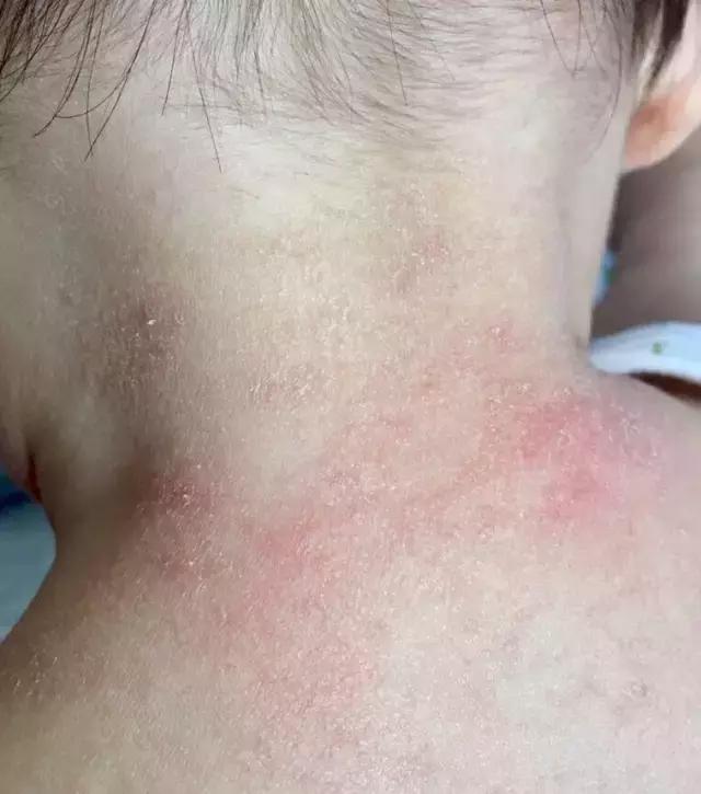 夏天身上总是各种「包」，对症下药，还你滑嫩肌肤！