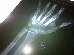 中国选手被摔伤,体坛悲剧32岁奥运冠军身亡