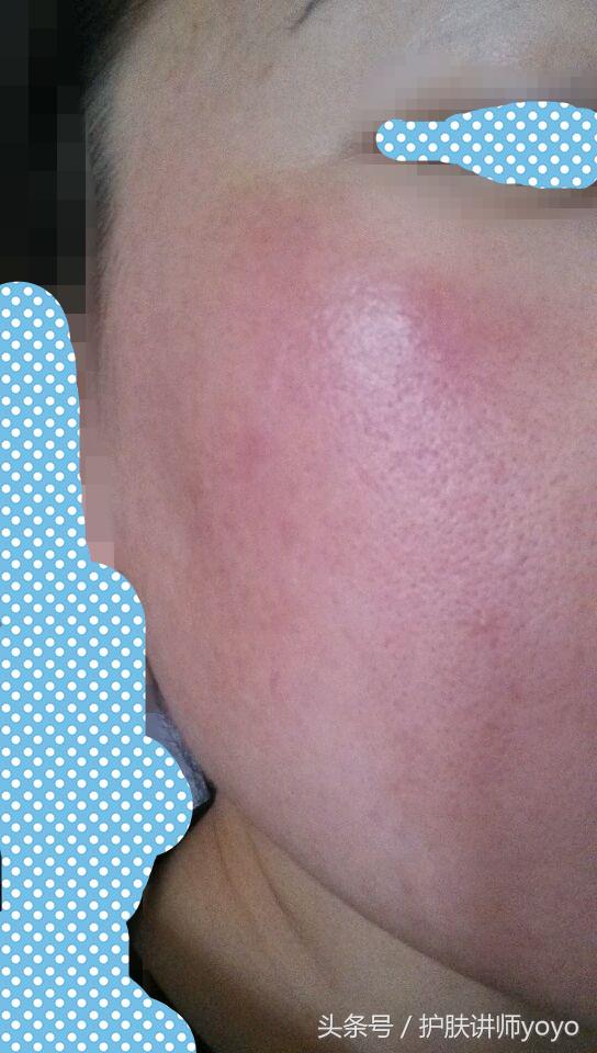 皮肤的皮脂膜受损怎么修复,皮脂膜受损皮肤干