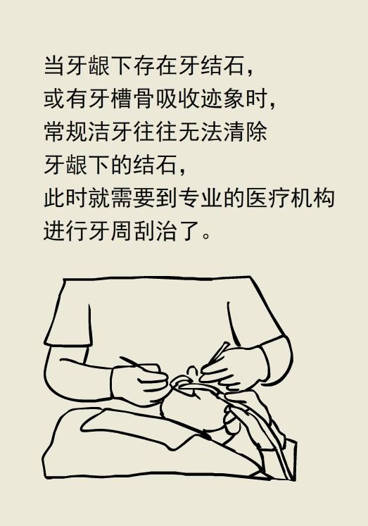 为什么洗牙以后还要做牙周刮治,为什么洗牙后还要刮治