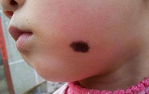 胎记表面粗糙像结痂,胎记表面有小疙瘩