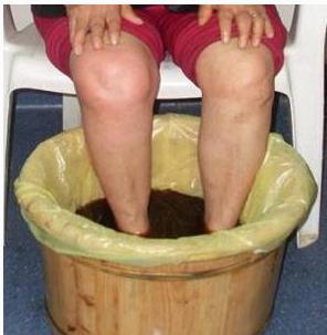 血友病患者膝盖肿怎么减轻疼痛,血友病关节疼痛为什么不能热敷