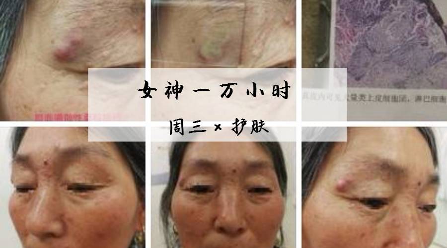 痘痘一直治不好的根本原因,痘痘是痤疮还是毛囊炎怎么判断