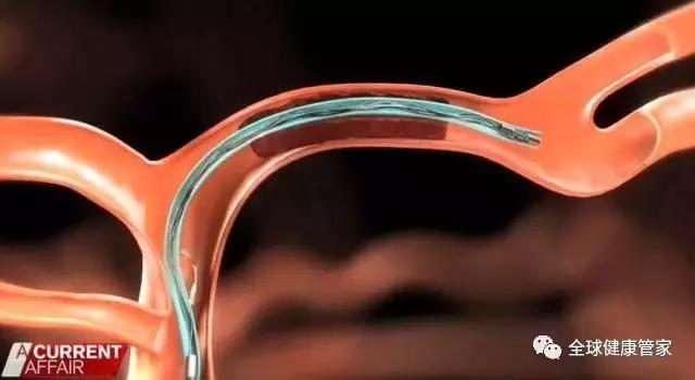 澳洲治疗中风可怕副作用,澳洲十大黑科技药