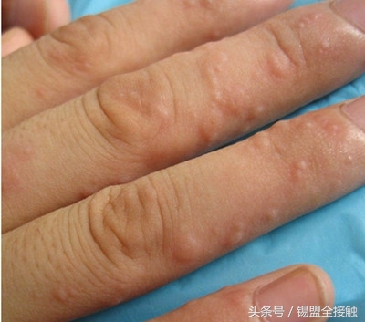 大人手上起了一个大水泡要当心了,手上起密密麻麻的小水泡是怎么了