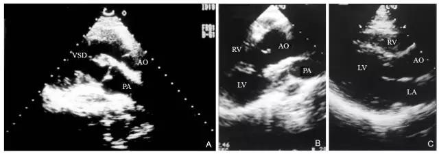 超声肺动脉瓣示意图,肺动脉左右分支超声视频