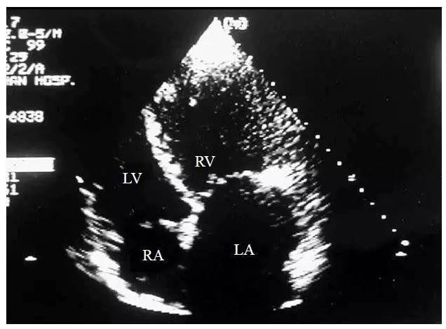 超声肺动脉瓣示意图,肺动脉左右分支超声视频