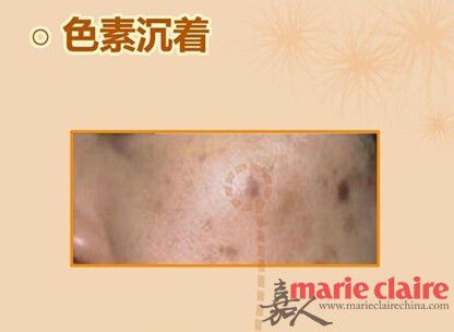 真正的痘印是可以祛的吗,暗紫色痘印是红痘印还是黑痘印