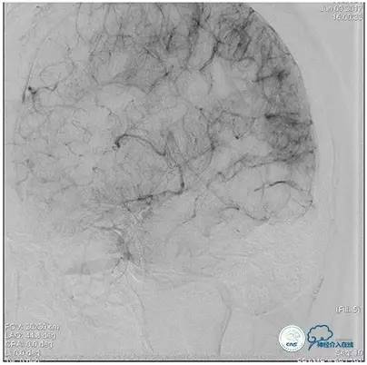 脑静脉窦狭窄做支架危险吗,静脉窦狭窄做支架后多久恢复