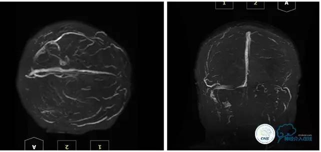 脑静脉窦狭窄做支架危险吗,静脉窦狭窄做支架后多久恢复