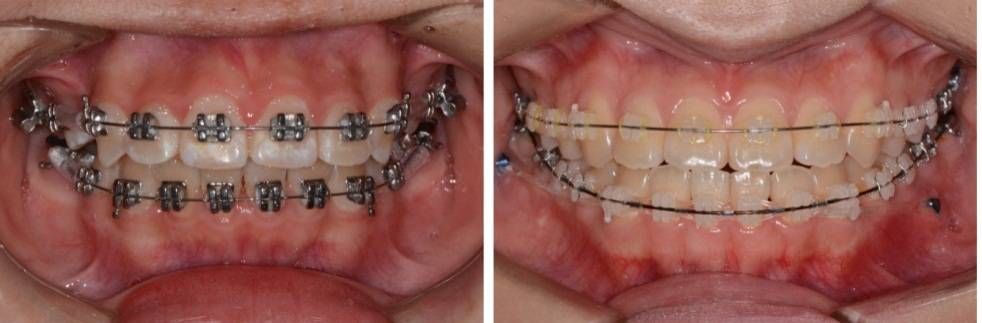 龅牙地包天怎么弄,龅牙怎么解决最好