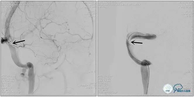 脑静脉窦狭窄做支架危险吗,静脉窦狭窄做支架后多久恢复