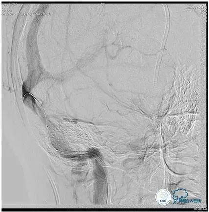 脑静脉窦狭窄做支架危险吗,静脉窦狭窄做支架后多久恢复