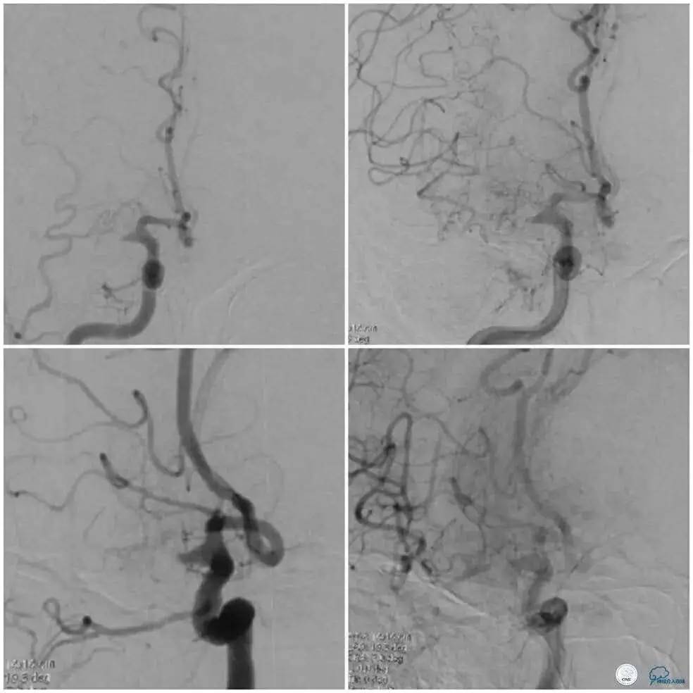 右侧大脑后动脉p1段狭窄支架手术,天坛周记