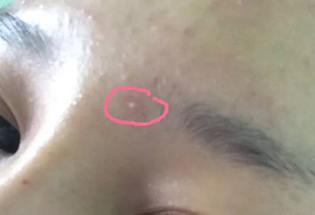 战痘合集完整版,战痘大结局完整版