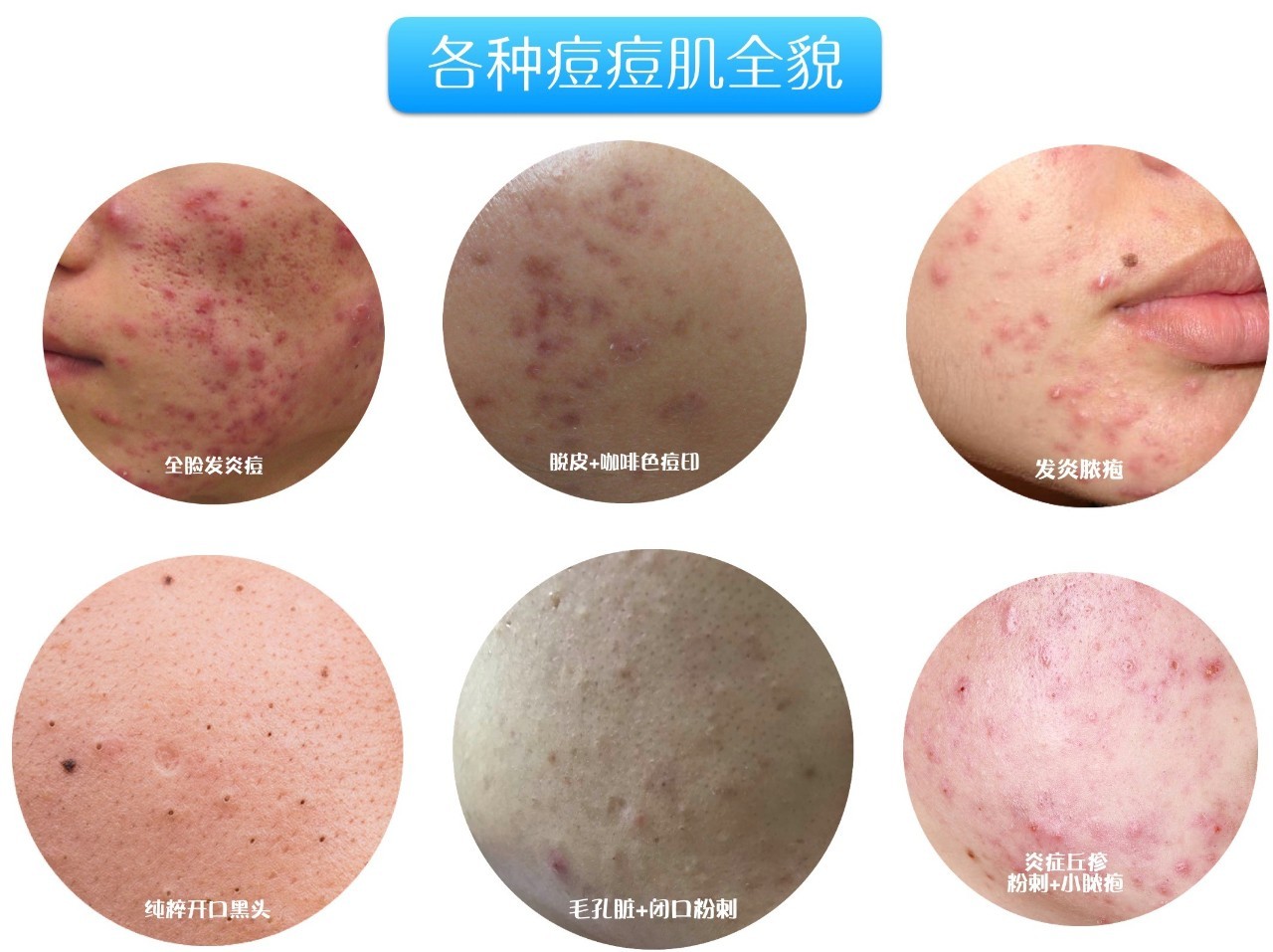 十年战痘血泪史详解,战痘知识分享