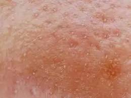 战痘合集完整版,战痘大结局完整版