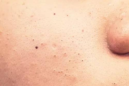 战痘合集完整版,战痘大结局完整版