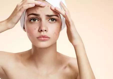 十年战痘血泪史详解,战痘知识分享