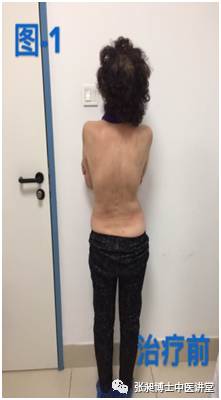 小针刀治疗脊柱侧弯,腰椎间盘突出脊柱侧弯的针刀治疗