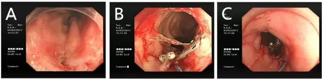 内镜荷包式缝合法视频,内镜下吻合口狭窄切开术