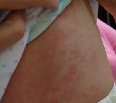 男童呕吐眼部突然起红点,15岁男童输液过敏休克