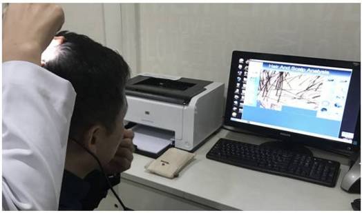 严重脱发秃顶发际线后移如何改善,长期熬夜导致发际线后移秃顶脱发