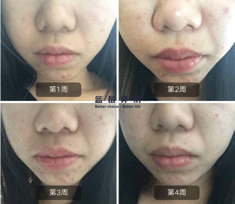 有哪些比较好用的美容仪可以推荐,最好用的有效的美容仪