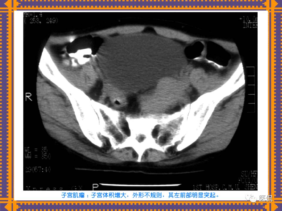 生殖系统疾病影像学诊断医学影像精品PPT