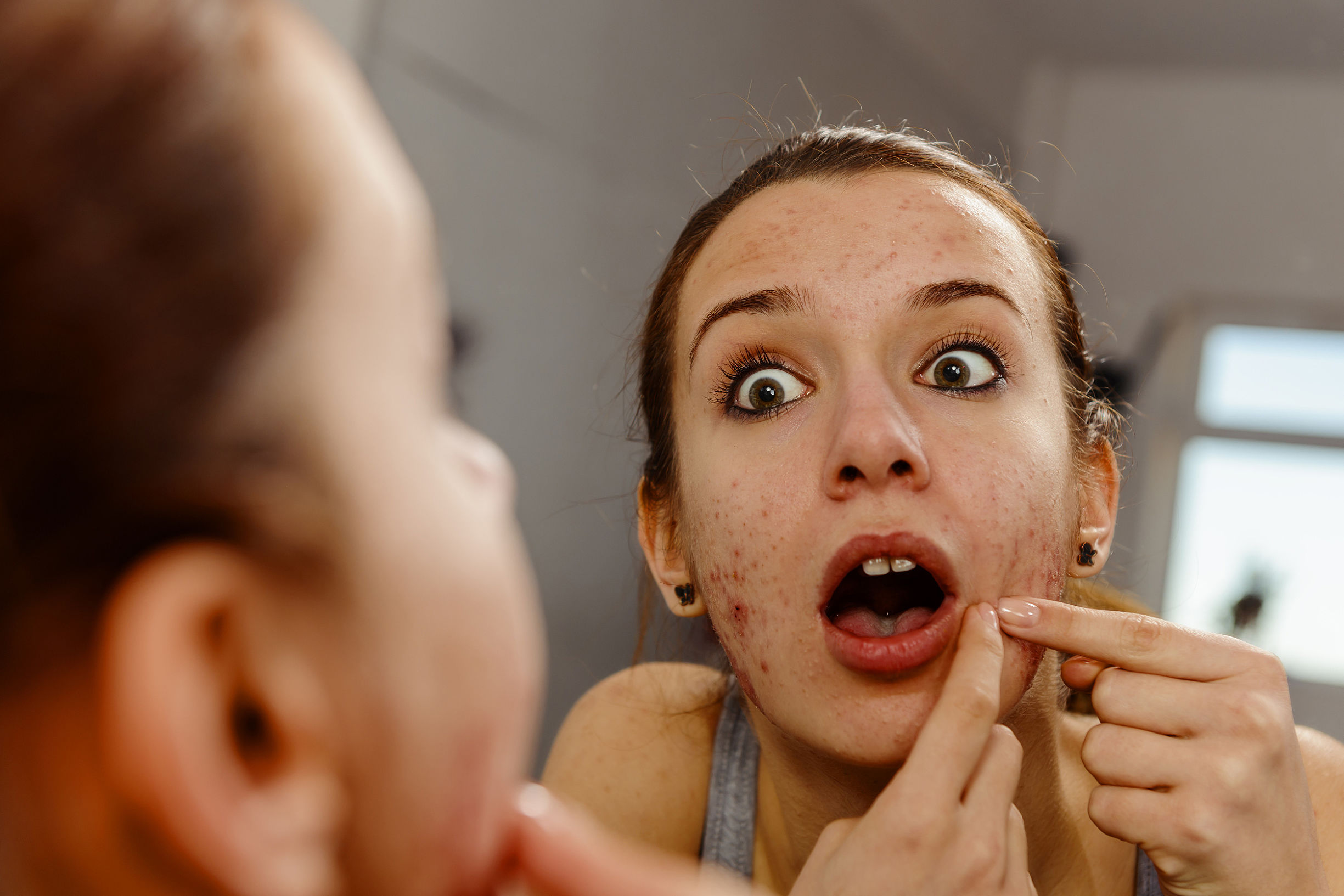 晒黑的黑色素怎么才能淡化,晒黑了去除黑色素就能白吗