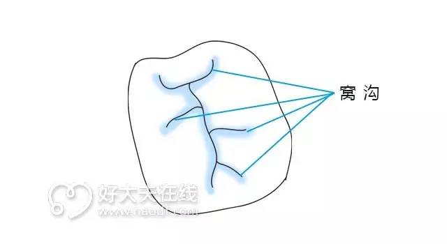 老牙缝隙太大经常塞牙怎么办,总塞牙怎么彻底解决