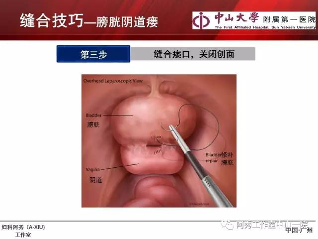 妇科腹腔镜下常用缝合技巧