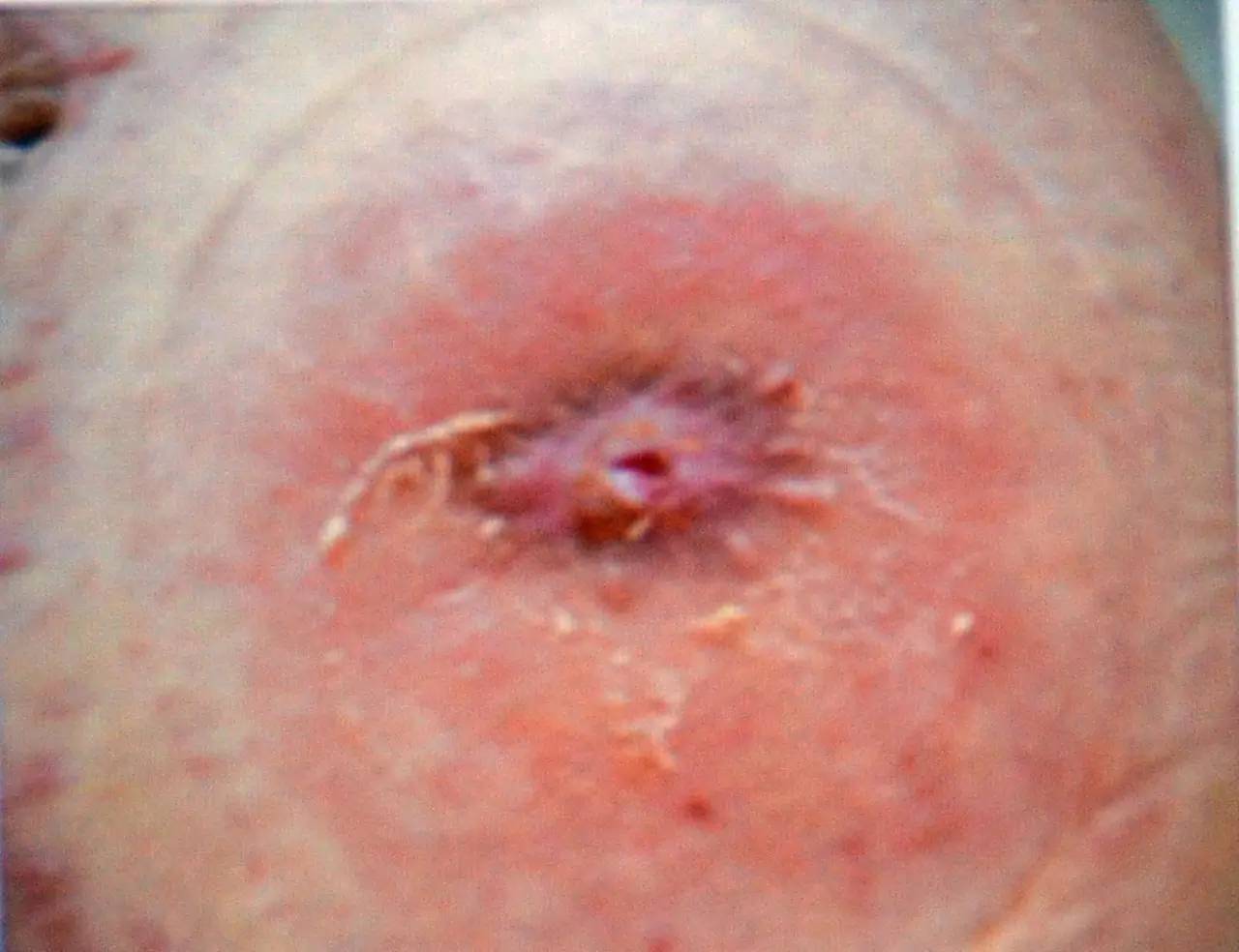 肠造口常见周围皮肤并发症,肠造口护理操作并发症