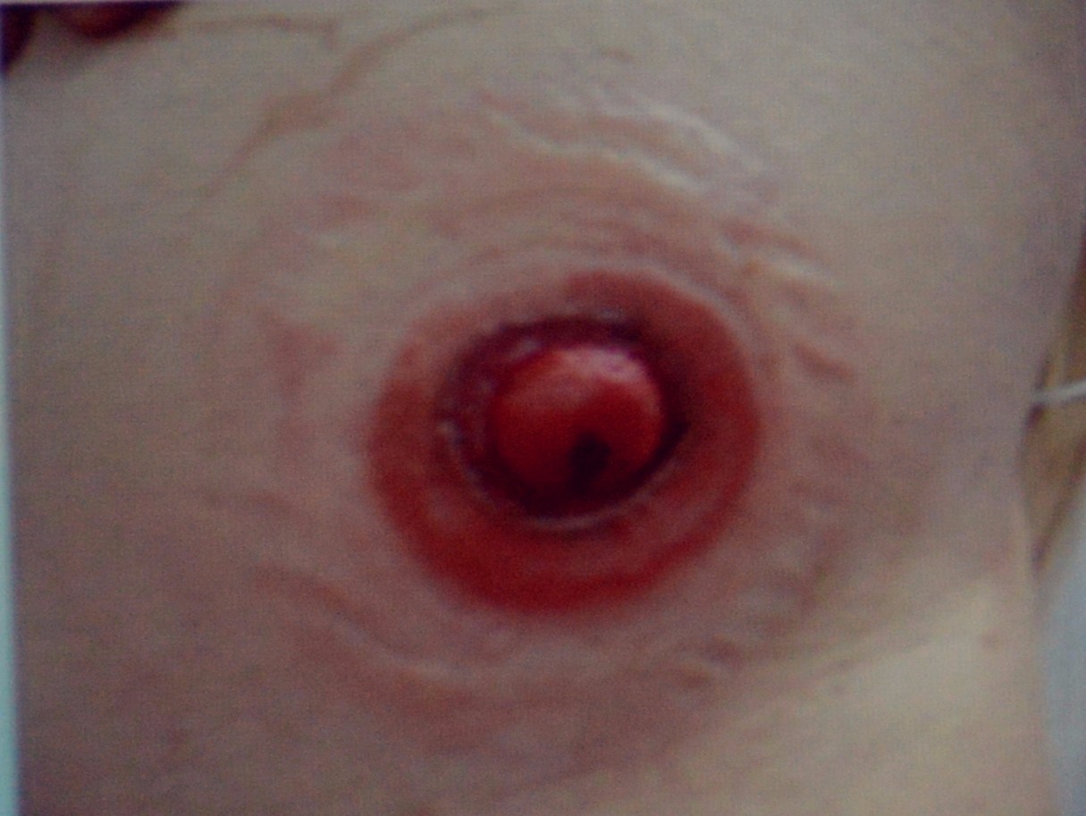 肠造口常见周围皮肤并发症,肠造口护理操作并发症