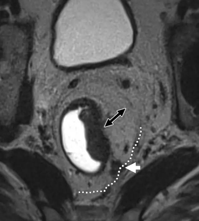 记住一个单词的一般方法,记住癌症九字诀