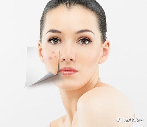 痘痘肌肤专用精油,十大最好用精油面部