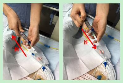 CVC堵管使用负压抽吸,轻轻松松搞定