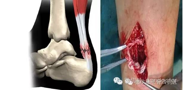 跟腱真的那么脆弱吗,跟腱为什么这么脆弱