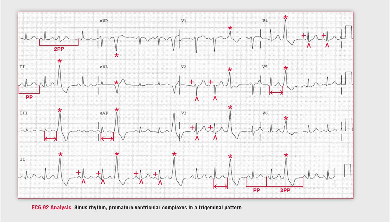 室早三联律是什么原因造成的,读心有术讲的是什么