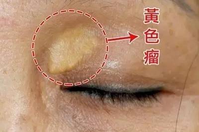 眼睛周围长一圈红色疙瘩红肿发烧,眼睛附近长了一片红疹子