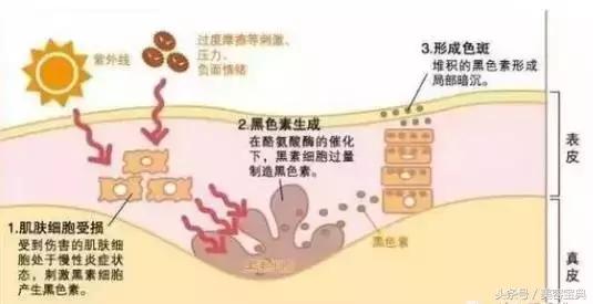 祛斑攻略各类色斑问题解决,祛斑先识斑辨证治斑方法多