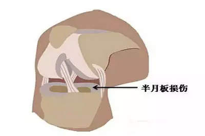 北医三院运动医学科徐雁：在门诊中经常看到的这几种膝伤，该怎么预防？