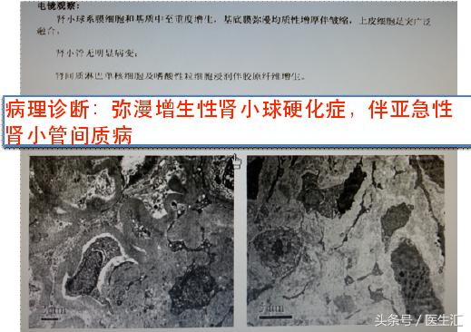 糖尿病肾病肾小管受损怎么治,慢性肾衰竭与糖尿病肾病鉴别诊断