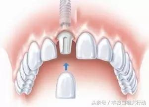 拔牙后镶牙的最佳时间,拔牙后镶牙最佳时间表