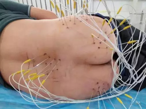 内热针是全针发热还是针尖发热,浮针治疗颈肩腰腿痛怎么样