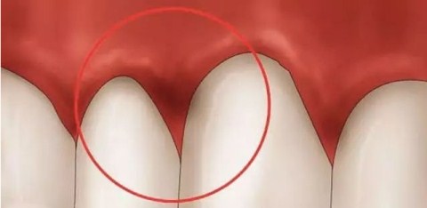 鐗欓緢鑲跨棝鎬庝箞杩涢,鐗欓緢鑲跨棝鎬庝箞杩涜娌荤枟