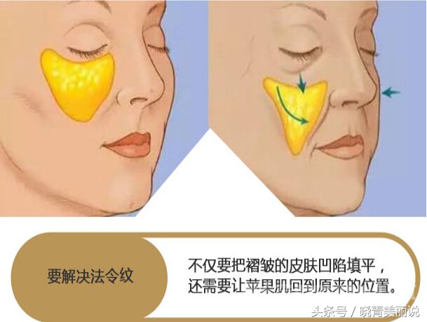 打完苹果肌脸僵了,打完苹果肌肿一块硬硬的