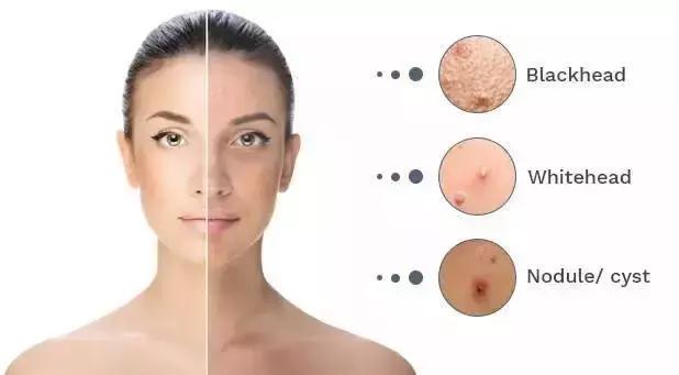 痘痘肌最好用的修护精华,治疗痘痘肌的护肤产品平价