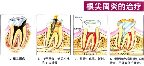 牙齿不舒服引起牙痛怎么办,坐飞机牙痛是怎么回事